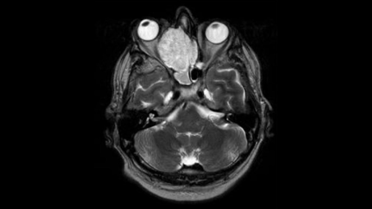 Juveniles Nasen-Rachen-Fibrom