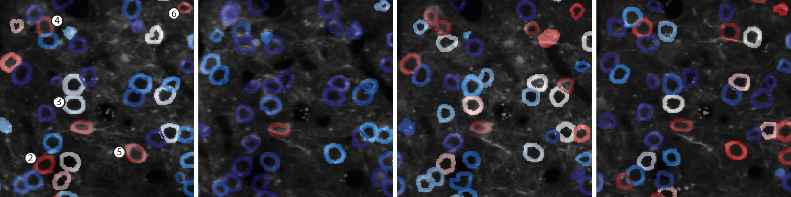 Models, markers and manipulation of inflammatory gray matter pathology