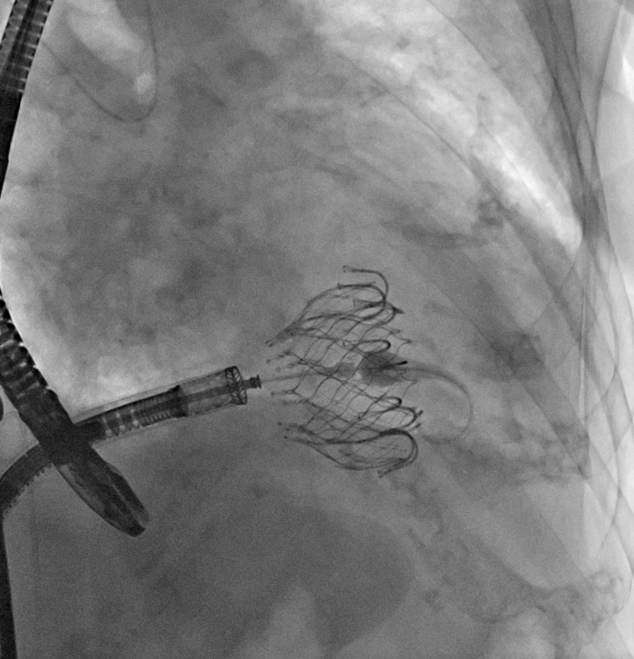 Orthotoper Trikuspidalklappenersatz