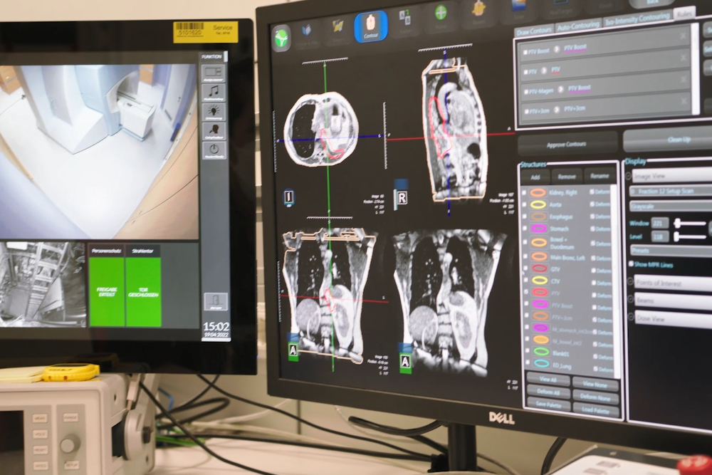 Bild: Planung Strahlentherapie
