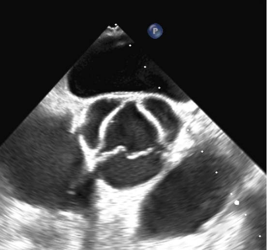 Aortenklappenstenose