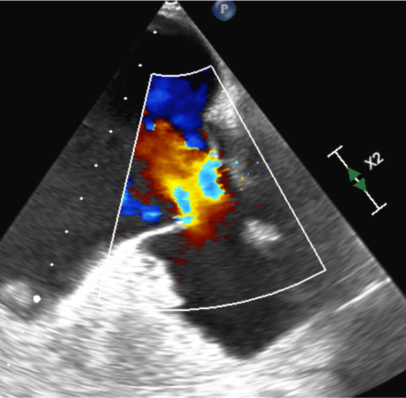 Echo einer Tricuspid regurgitation