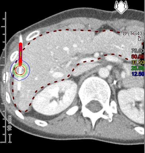 CT-geführte, interstitielle Brachytherapie