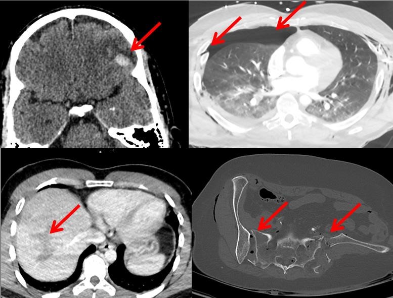 Ganzkörper-CT nach schwerem Trauma mit Zeichen einer Hirnblutung, eines Pneumothorax, einer Leberlazeration sowie schweren Beckenfraktur