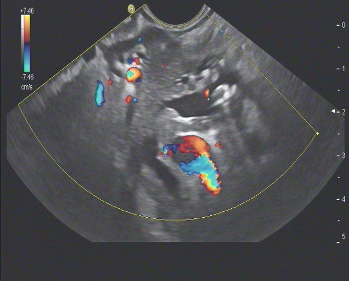 Intraduktale Calculi EUS