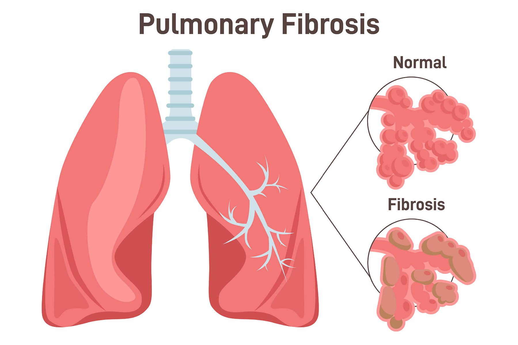 pulmonary fibrosis