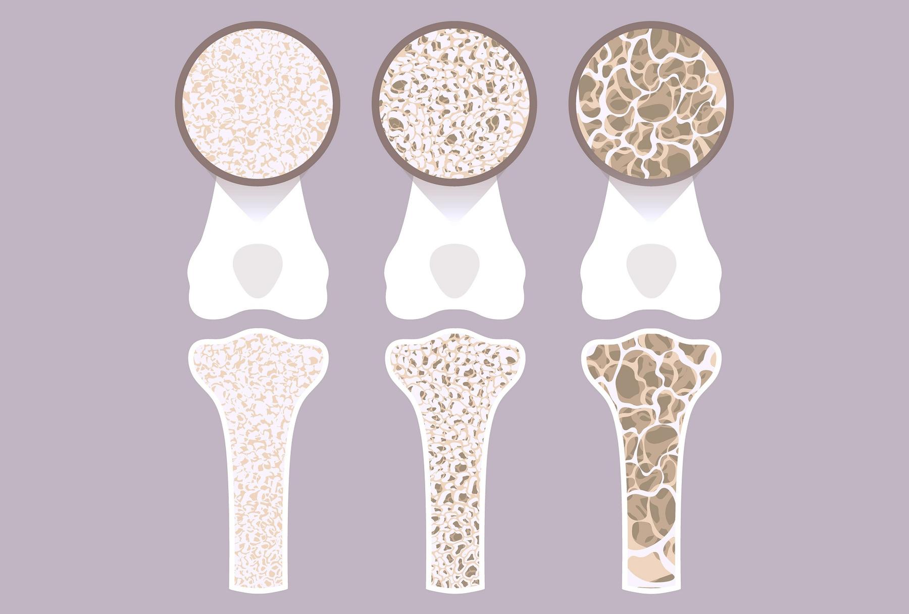 Grafische Darstellung der Osteoporose-Stadien