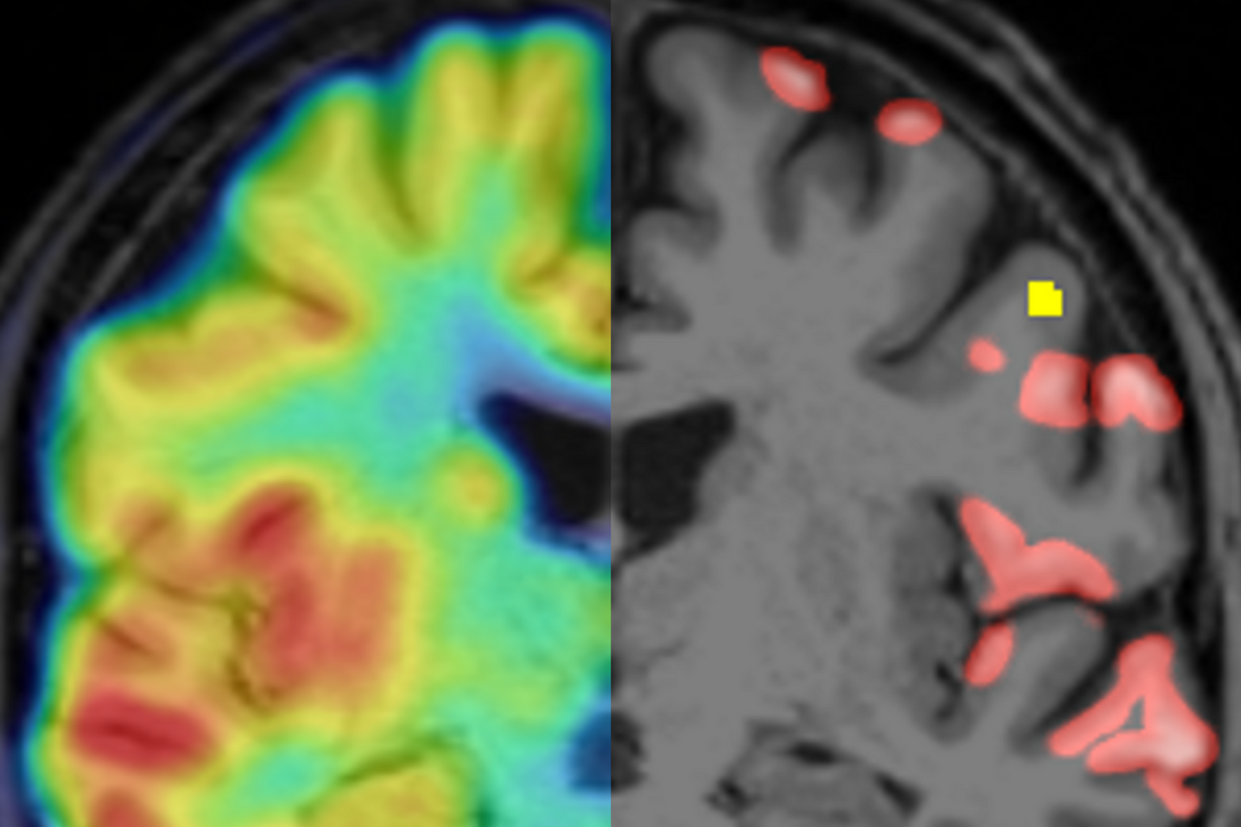PET-MRI