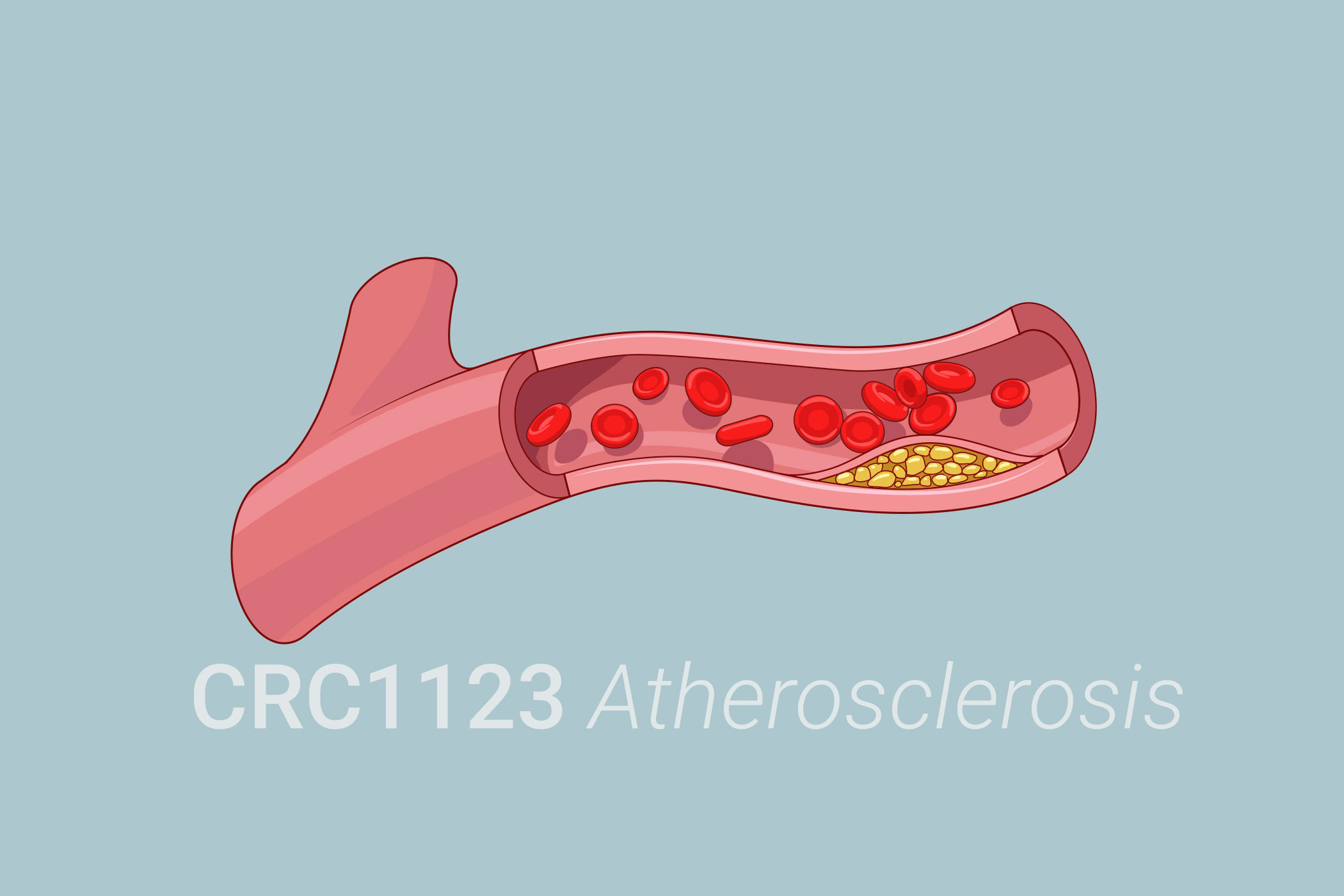 atherosclerosis-AdobeStock_94137750