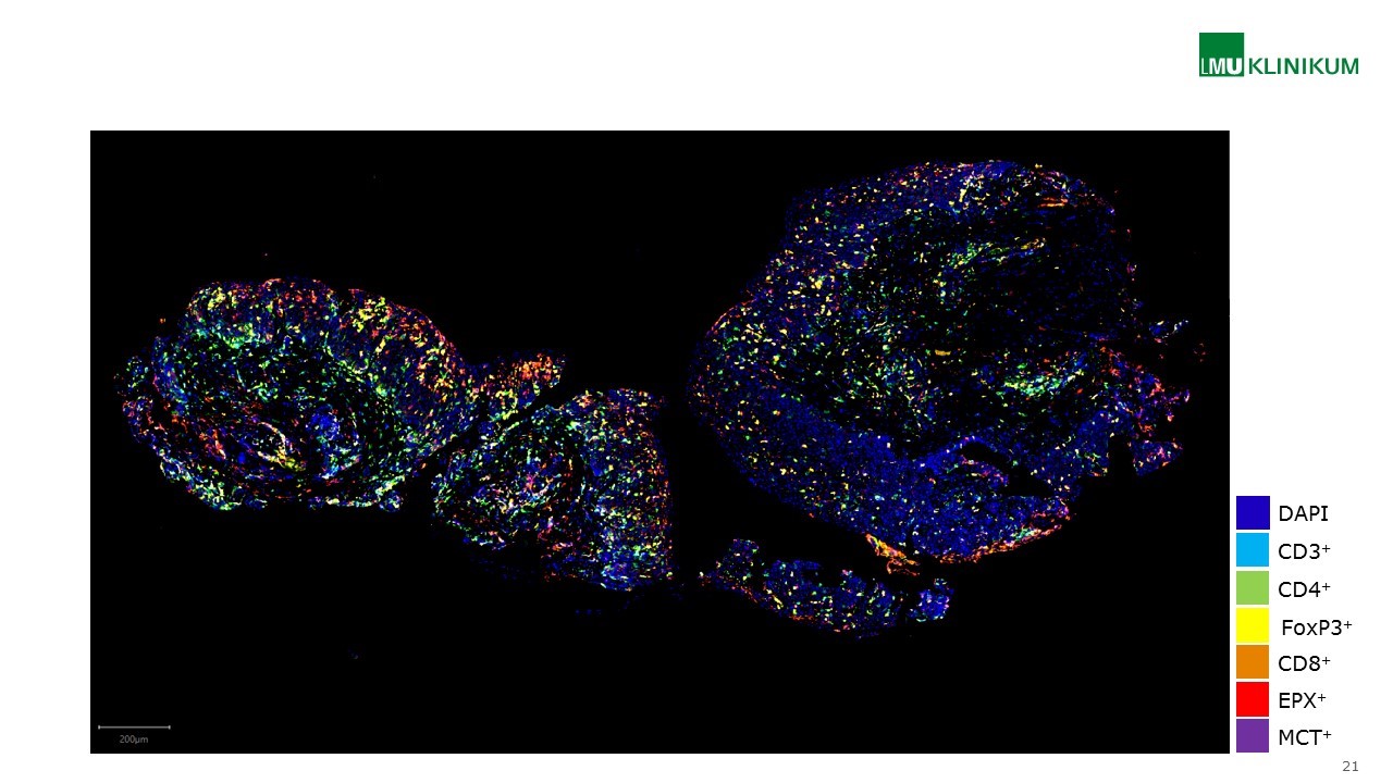 Abbildung 1: Multiplex-Immunfluoreszenzfärbung einer Ösophagusbiopsie. Von einem Patienten mit aktiver Eosinophiler Ösophagitis ist eine Ösophagusbiopsie in der Übersicht gezeigt (Maßstab siehe links unten im Bild). Neben der Kernfärbung (DAPI) wurden eosinophile Granulozyten (EPX+), Mastzellen (MCT+) und T-Zellsubpopulationen (CD3+, CD4+, CD8+, FoxP3+) angefärbt.