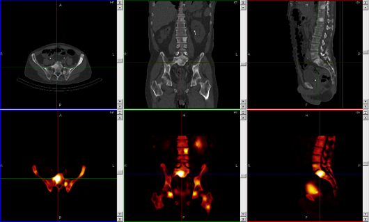 SPECT und SPECT/CT