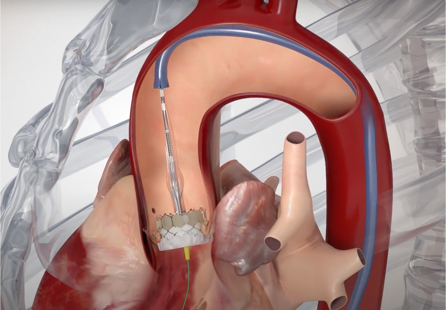 TAVR-Therapie von Edwards