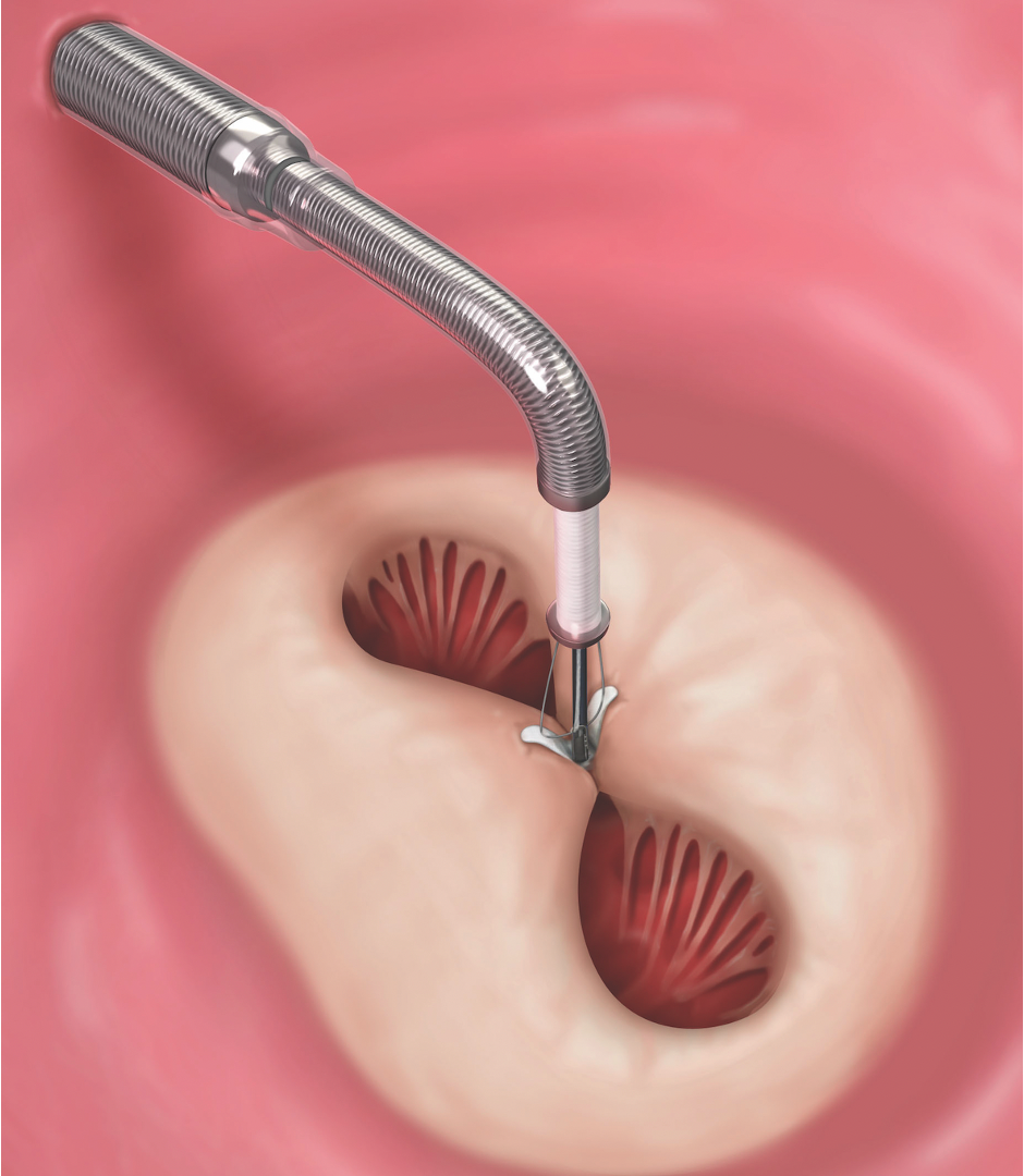 Abbott Cardiovascular
