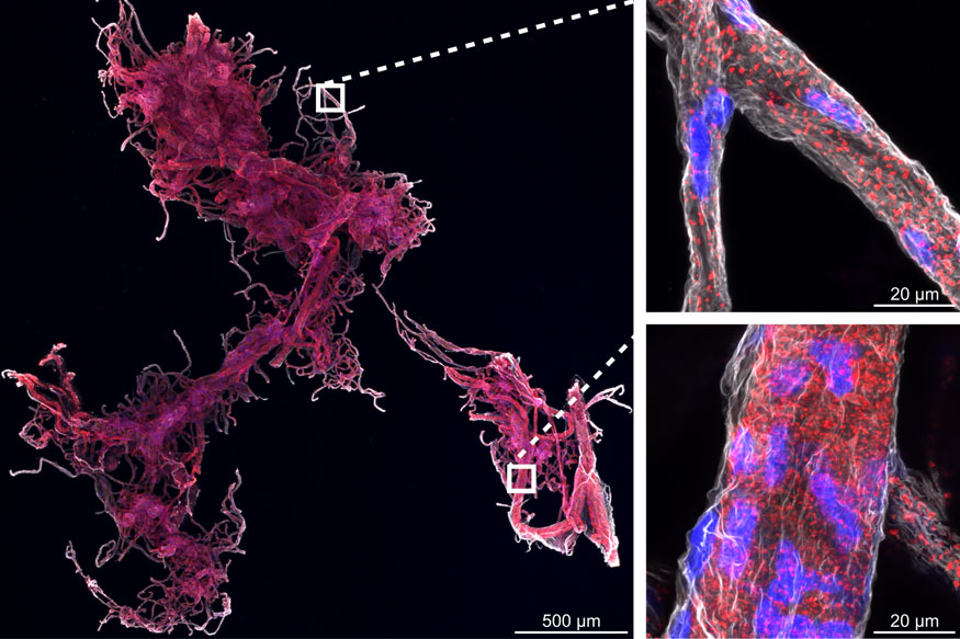 HTRA1 loss-of-function in CADASIL