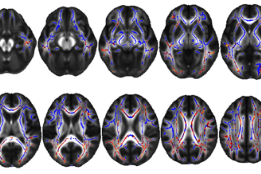 White matter alterations