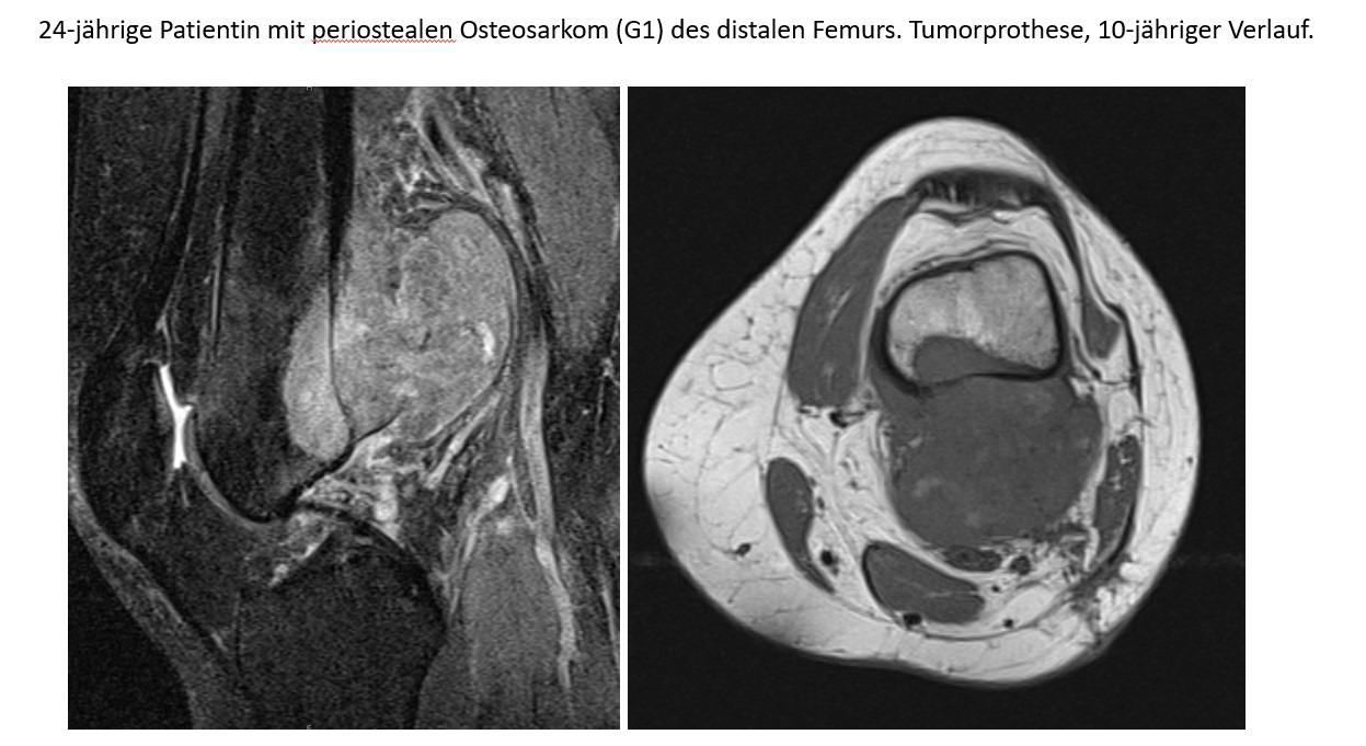 Osteosarkom distales Femur