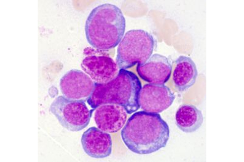Blastenhaufen bei AML