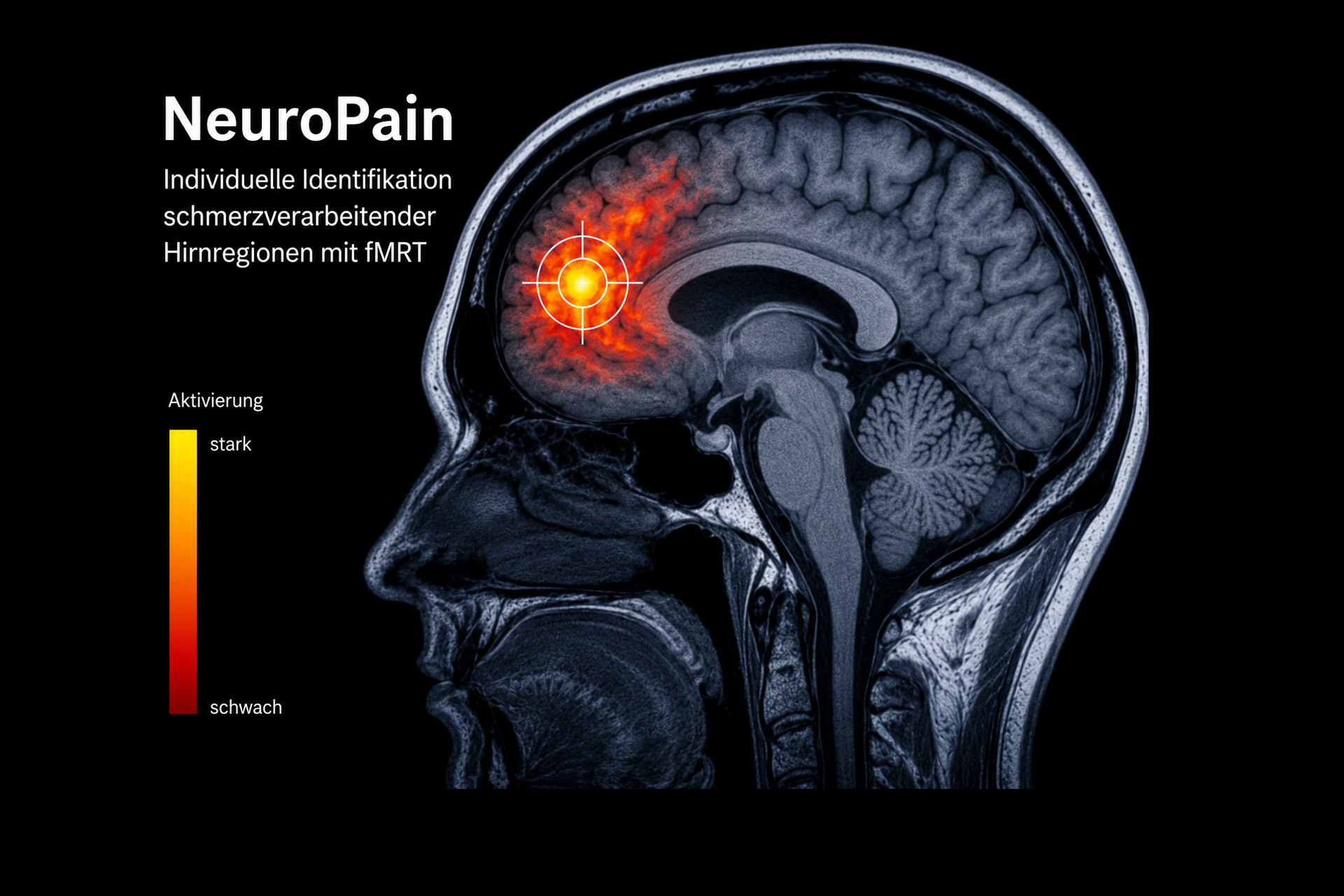 NeuroPain - Personalisiert gegen chronische Rückenschmerzen